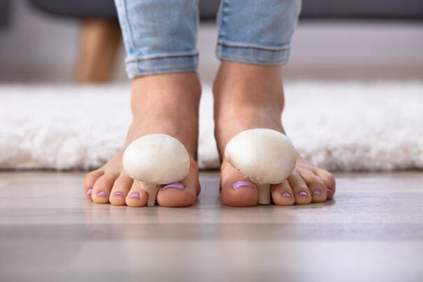 Champignon sur les ongles