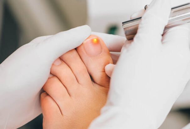 Traitement au laser pour les champignons sur les ongles des pieds