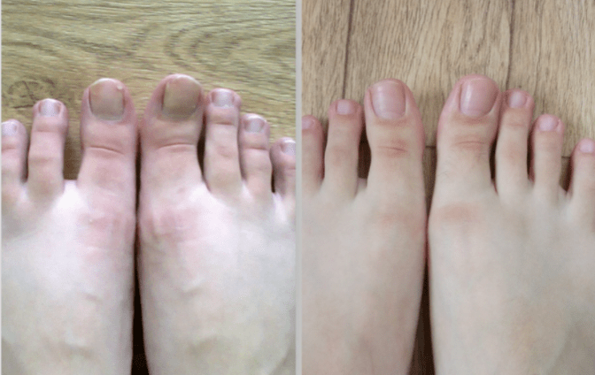 avant et après le traitement de la mycose des ongles des pieds