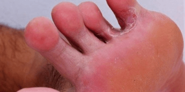 Le champignon sur les jambes