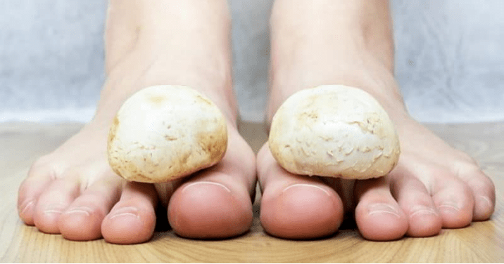Traitement rapide des champignons sur les jambes à la maison