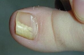 Les raisons de l'apparence du champignon sur le pouce de la jambe