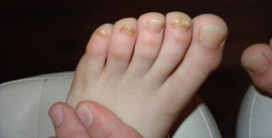 Les trichophytes sont rouges