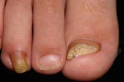 Micose de ongles sur les jambes