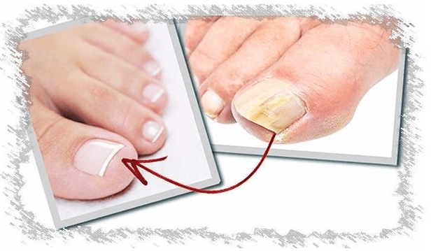 Causes de champignons à ongles