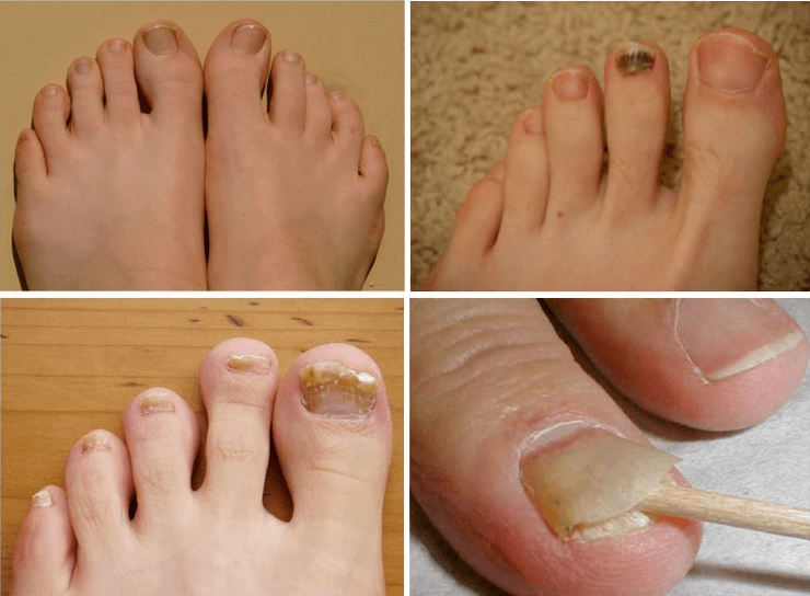 Signes de champignon d'ongles