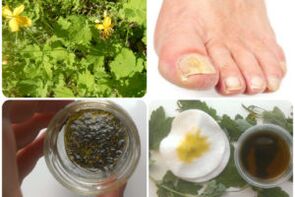 Remèdes populaires contre la mycose des ongles des pieds