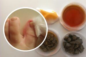 Traitement de la mycose des ongles des pieds avec des remèdes populaires